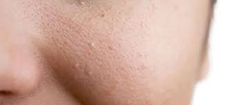 6 Cách trị mụn li ti tại nhà cấp tốc cho da sạch mụn tức thì | Shynh Beauty