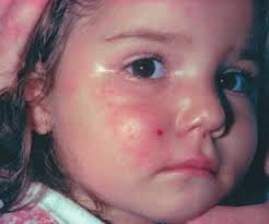 Forum: Recherche in PädInform Fortbildung: Herpes Zoster Berufsfragen:  Priorisierung oder Rationalisierung Magazin: Wie es dazu