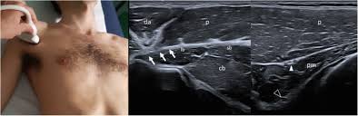 Lateral ankle injury assessment online course: Consensus Based Recommendations For Diagnosis And Medical Management Of Poland Syndrome Sequence Orphanet Journal Of Rare Diseases Full Text