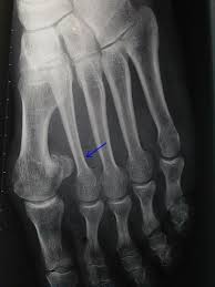 La Fracture Des Metatarsiens Les 1001 Pieds