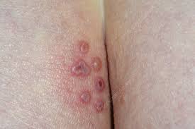 Www firstderm com wp content uploads fungal infect. Herpes On The Buttocks Stock Image C026 3431 Science Photo Library