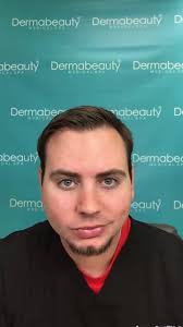 Temple hollowing, also known as temporal atrophy or temporal wasting occurs  when the temple shrinks causing a hollowed out appearance to the temple.  #templefiller #dermabeautymedspa #allergan #botox ...