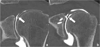 Image result for Shoulder Imaging