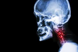 Check spelling or type a new query. Espondilosis Cervical Sintomas Y Tratamientos Naturales Mejor Con Salud