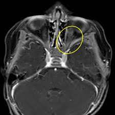 Morning Glory Disc Anomaly Eurorad