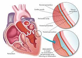• the incubation period for urogenital gonorrhea in women is unclear, but those who develop symptomatic gonococcal infection do so within 10 days. Pericarditis Stock Illustrations 141 Pericarditis Stock Illustrations Vectors Clipart Dreamstime
