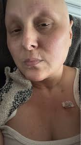 Two down, two more chemo's to go and I think like 17 radiations. I think  they are frying my esophagus a little but part of the possible side affect.  Feel like severe