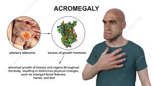 Image result for Acromegaly
