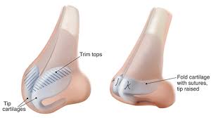They are correction of congenital deformities and those arising from. Rhinoplasty In India Is Affordable Rhinoplasty Cost In India