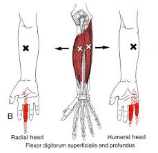 If the finger is broken, the symptoms include numbness, sharp pain as well as swelling. Image Result For Pinky Finger Trigger Point Trigger Points Trigger Point Therapy Massage Therapy
