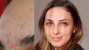Glycolic Acid For Dark Spots Acne Scars Hyperpigmentation More Youtube