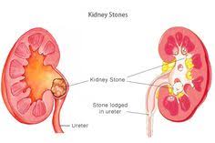 Rghospital Rg Stone Hospital Has Been The First Hospital To Treat The Youngest Patient With Stone 6 M Homeopathy Essential Oils Kidney Stones Kidney Stones