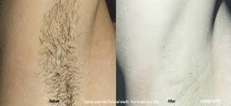Here's what you need to know: Laser Hair Removal Hughes Surgical Arts Lowell Hughes Md Lower South Hill Anguilla British West Indies Hughessurgical Com