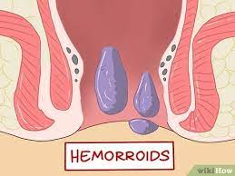 الاعتناء بحالة البواسير بعد الولادة wikihow