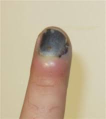Yellow nail syndrome also known as primary lymphedema is a rare genetic disorder. Nail Bed Injuries Juniorbones