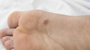 Water is used when body fluid is not sufficient, for example when ensuring verruca removal. Plantar Warts Treatment And Causes