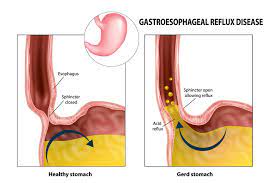Gerd Or Heart Attack Md Knowledge Health Journal