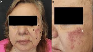 Image result for demodex rosacea
