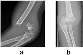 A fracture of the medial epicondyle of the elbow that is the third most common fracture seen in children and is usually seen in boys between the age of 9 and 14. Common Paediatric Elbow Injuries Fulltext