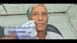 Fix dental teeth with out removal of old teeth