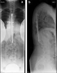 Entdecke rezepte, einrichtungsideen, stilinterpretationen und andere ideen zum ausprobieren. Serum Metal Ion Levels In Adolescent Idiopathic Scoliosis Ais Patients 25 Years After Treated With Harrington Rod Instrumentation Or Bracing Springerlink