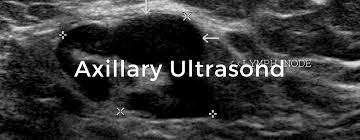 To look more closely at a. Axillary Ultrasound Breast Cancer School For Patients