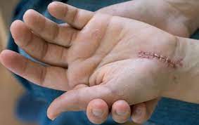 We did not find results for: Carpal Tunnel Pain Worse After Carpal Tunnel Surgery The Carpal Solution