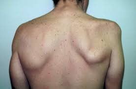 Brachial Neuritis Causes Symptoms Diagnosis Treatment Prognosis