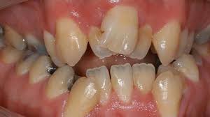 Sie füllen eine lücke im kiefer hinter dem bisher letzten milchzahn. Schiefe Zahne Kieferorthopadie Lippstadt Dr Bianca Mertens