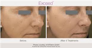 We did not find results for: Microneedling Wrinkless Acne Treatment Greenville Sc