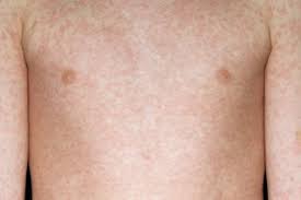 This type of miliaria affects neonates with highest occurrence at two weeks of age or less. Measles Symptoms Nhs