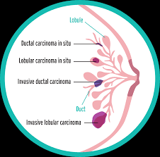 There are many different types of breast cancer. What Is Breast Cancer Bebrcaware
