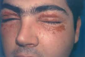 Dermatitis En Parpados Actas Dermo Sifiliograficas