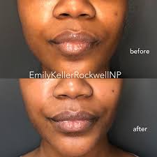 Now, following the procedure, i sometimes notice my jaw getting tired while chewing gum — something i haven't been generally, botox lasts anywhere from three to five months, depending on how each person metabolizes it. Tmj Pain The Montchanin Center
