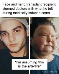 Face and hand transplant recipient stunned doctors with what he felt during  medically induced coma (link in the comments)