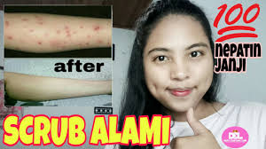 Kompres bekas luka dengan bantalan hangat. Scrub Alami Menghilangkan Bekas Luka Di Kaki Tangan Wajah 100 Ampuh Desy Cahyani Lari Youtube