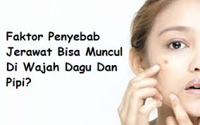 Masalah lain dari jerawat di pipi adalah kondisi jerawat yang meradang sering kali menyebabkan wajah menjadi merah. Faktor Penyebab Jerawat Bisa Muncul Di Wajah Dagu Dan Pipi Omjamal Com