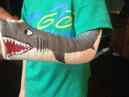 13 Pieces Of Cast Art That Make Breaks Seem Not So Bad Cast Art Broken Arm Cast Arm Cast