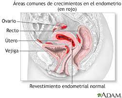 Endometriosis Medlineplus Enciclopedia Medica