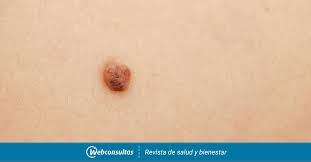 El melanoma es un tipo de cáncer de piel que aparece cuando las células llamadas melanocitos empiezan a crecer de forma descontrolada.estas células elaboran un pigmento llamado melanina, responsable del color de la piel, del pelo y del iris de los ojos. Cancer De Piel Causas Sintomas Y Tratamiento
