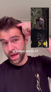 Is keeps worth it? #balding #hairgrowth #hair #malebaldness