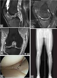 Control swelling and pain without the use of drugs. A 35 Year Old Man With Pain After Acl Reconstruction Meniscal Repair And Partial Meniscectomy