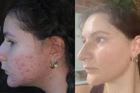 12 Weeks to Glowing Skin