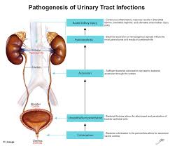 Renal failure may be classified as prerenal when secondary to a reduction in the renal perfusion pressure gradient, renal when the result of intrinsic disease of the renal parenchyma, and postrenal when secondary to an abnormality of urine outflow. Urinary Tract Infection Renal Medbullets Step 1
