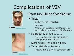 Ramsay Hunt Syndrome Causes Symptoms Syndrome Body Disorders Facial Nerve