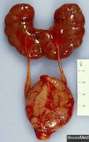 Horseshoe Kidneys Renal Kidney Health Medical Photos