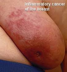 The skin of the breast may also appear pink, reddish purple, or. Inflammatory Breast Cancer Moose And Doc