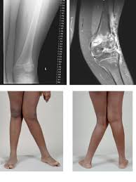 Journal your back and leg pain regarding your leg and back pain, it may be helpful to keep a journal of your activities, documenting when the pain began, the activities that aggravate your pain and those that relieve your symptoms. Genu Valgum Wikipedia