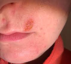A chemical burn can occur when a person comes in direct contact with a chemical or its fumes. Skin Concerns Review To S Salicylic Acid 2 Solution Gave Me A Small But Painful Chemical Burn To Anyone Considering Use Of This Product Its Not Worth The Risk Any Suggestions For Treatment