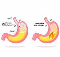 الارتجاع المعدي المريئي – الدكتور رائد أبو غوش